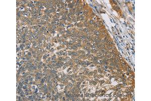 Immunohistochemistry of Human thyroid cancer using TNFRSF10D Polyclonal Antibody at dilution of 1:40 (DcR2 Antikörper)