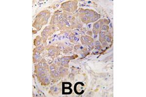 Formalin-fixed and paraffin-embedded human breast carcinoma tissue reacted with HSPB1 polyclonal antibody  , which was peroxidase-conjugated to the secondary antibody, followed by DAB staining. (HSP27 Antikörper  (Ser82))