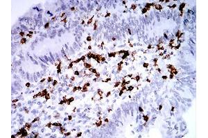 Immunohistochemical analysis of paraffin-embedded rectum cancer tissues using CD2 mouse mAb with DAB staining. (CD2 Antikörper  (AA 25-140))