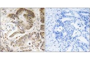 Immunohistochemistry analysis of paraffin-embedded human colon carcinoma tissue, using PIK3R5 Antibody. (PIK3R5 Antikörper  (AA 695-744))