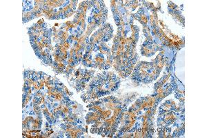 Immunohistochemistry of Human esophagus cancer using CLPTM1L Polyclonal Antibody at dilution of 1:60