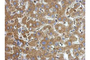 IHC-P Image Immunohistochemical analysis of paraffin-embedded human hepatoma, using alpha-1-Microglobulin, antibody at 1:500 dilution. (AMBP Antikörper)