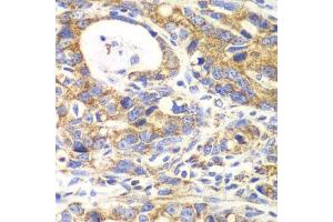 Immunohistochemistry of paraffin-embedded human gastric cancer using GLUD2 antibody. (GLUD2 Antikörper  (AA 319-558))