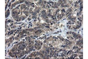 Immunohistochemical staining of paraffin-embedded Adenocarcinoma of Human ovary tissue using anti-DOK7 mouse monoclonal antibody. (DOK7 Antikörper)