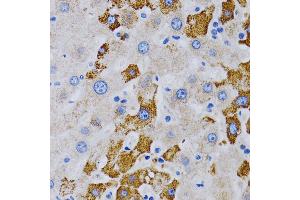 Immunohistochemistry of paraffin-embedded human liver cancer using CYP24 antibody (805) at dilution of 1:200 (40x lens). (CYP24A1 Antikörper  (AA 36-448))