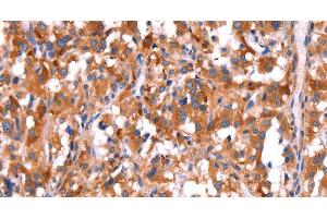 Immunohistochemistry of paraffin-embedded Human thyroid cancer tissue using GCG Polyclonal Antibody at dilution 1:40 (Glucagon Antikörper)