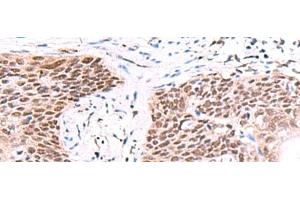 Immunohistochemistry of paraffin-embedded Human esophagus cancer tissue using IRF2BP1 Polyclonal Antibody at dilution of 1:40(x200) (IRF2BP1 Antikörper)