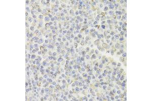 Immunohistochemistry of paraffin-embedded human B cell lymphoma using CD74 Antibody (ABIN5973310) at dilution of 1/100 (40x lens). (CD74 Antikörper)