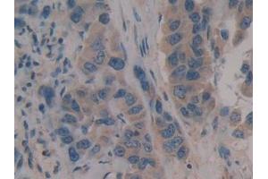 Detection of CD109 in Human Breast cancer Tissue using Polyclonal Antibody to Cluster Of Differentiation 109 (CD109) (CD109 Antikörper  (AA 1146-1390))