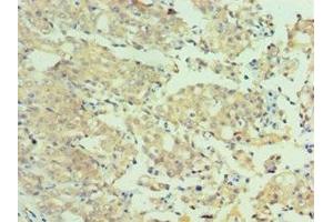 Immunohistochemistry of paraffin-embedded human colon cancer using ABIN7160651 at dilution of 1:100 (MTMR4 Antikörper  (AA 570-820))