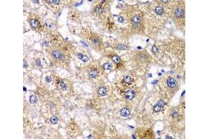 Immunohistochemistry of paraffin-embedded Human liver damage using AMY2A Polyclonal Antibody at dilution of 1:100 (40x lens). (AMY2A Antikörper)