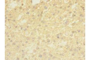 Immunohistochemistry of paraffin-embedded human glioma using ABIN7173241 at dilution of 1:100 (TMEM56 Antikörper  (AA 232-263))