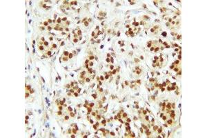 IHC-P: CTBP2 antibody testing of human breast cancer tissue (CTBP2 Antikörper  (C-Term))