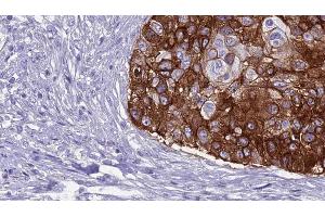 ABIN6269007 at 1/100 staining Human urothelial cancer tissue by IHC-P. (GRM8 Antikörper  (C-Term))