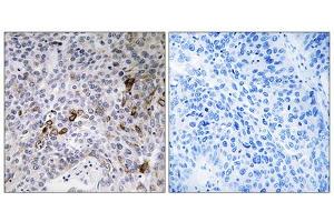 Immunohistochemistry analysis of paraffin-embedded human lung carcinoma tissue using RAB11FIP3 antibody. (RAB11FIP3 Antikörper  (C-Term))