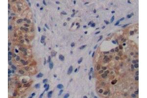 Detection of ErbB2 in Human Breast cancer Tissue using Monoclonal Antibody to Receptor Tyrosine Protein Kinase erbB-2 (ErbB2) (ErbB2/Her2 Antikörper  (AA 376-578))