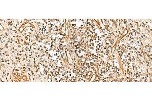 Immunohistochemistry of paraffin-embedded Human prost ate cancer tissue using HUS1 Polyclonal Antibody at dilution of 1:65(x200) (HUS1 Antikörper)