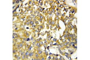 Anti-Pleiotrophin antibody, IHC(P) IHC(P): Human Mammary Cancer Tissue (Pleiotrophin Antikörper  (C-Term))