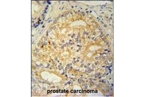 C antibody (N-term) (ABIN654965 and ABIN2844604) immunohistochemistry analysis in formalin fixed and paraffin embedded human prostate carcinoma followed by peroxidase conjugation of the secondary antibody and DAB staining. (C16ORF13 Antikörper  (N-Term))