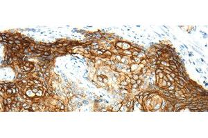 Immunohistochemistry of paraffin-embedded Human cervical cancer using AQP3 Polyclonal Antibody at dilution of 1/30 (AQP3 Antikörper)