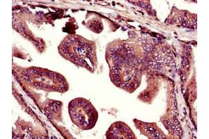 Immunohistochemistry of paraffin-embedded human prostate tissue using ABIN7169055 at dilution of 1:100 (UHMK1 Antikörper  (AA 183-385))