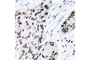 Immunohistochemistry of paraffin-embedded human esophageal cancer using A Rabbit mAb (ABIN7265699) at dilution of 1:100 (40x lens). (ARID1A Antikörper)