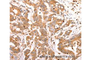 Immunohistochemistry of Human lung cancer using CELSR2 Polyclonal Antibody at dilution of 1:50 (CELSR2 Antikörper)
