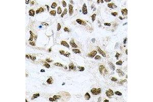 Immunohistochemical analysis of MCM6 staining in human lung cancer formalin fixed paraffin embedded tissue section. (MCM6 Antikörper)