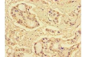 Immunohistochemistry of paraffin-embedded human pancreatic cancer using ABIN7166091 at dilution of 1:100 (MBTPS1 Antikörper  (AA 17-70))