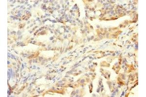 Immunohistochemistry of paraffin-embedded human lung cancer using ABIN7155913 at dilution of 1:100 (HCFC1R1 Antikörper  (AA 1-119))