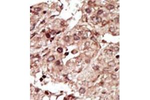 Formalin-fixed and paraffin-embedded human cancer tissue (hepatocarcinoma) reacted with the primary antibody, which was peroxidase-conjugated to the secondary antibody, followed by AEC staining. (PHKG1 Antikörper  (Middle Region))