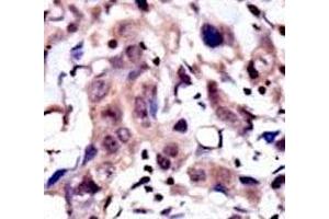 IHC analysis of FFPE human breast carcinoma tissue stained with the MUSK antibody (MUSK Antikörper  (AA 35-65))