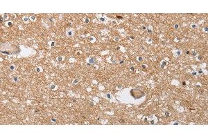 Immunohistochemistry of paraffin-embedded Human brain tissue using SOCS2 Polyclonal Antibody at dilution 1:40 (SOCS2 Antikörper)