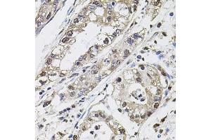 Immunohistochemistry of paraffin-embedded human gastric cancer using Carbonic Anhydrase 9 (C/G250) antibody (ABIN6131266, ABIN6137798, ABIN6137800 and ABIN6217767) at dilution of 1:100 (40x lens). (CA9 Antikörper  (AA 52-151))