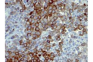 Formalin-fixed, paraffin-embedded human Melanoma stained with NGFR Monoclonal Antibody (NTR/912). (NGFR Antikörper)