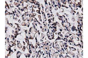 Immunohistochemical staining of paraffin-embedded Adenocarcinoma of Human colon tissue using anti-OGFOD1 mouse monoclonal antibody. (OGFOD1 Antikörper)