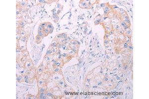 Immunohistochemistry of Human breast cancer using ADAMTS14 Polyclonal Antibody at dilution of 1:50 (ADAMTS14 Antikörper)