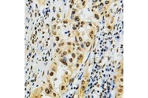 Immunohistochemical analysis of POLR3B staining in human lung cancer formalin fixed paraffin embedded tissue section. (POLR3B Antikörper)