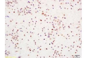 Formalin-fixed and paraffin embedded human brain glioblastoma labeled with Rabbit Anti YBX-1/YB1 Polyclonal Antibody, Unconjugated (ABIN759851) at 1:200 followed by conjugation to the secondary antibody and DAB staining (YBX1 Antikörper)