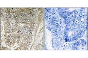 Immunohistochemistry analysis of paraffin-embedded human colon carcinoma tissue, using RPL37A Antibody. (RPL37A Antikörper  (AA 21-70))