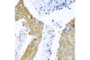 Immunohistochemistry of paraffin-embedded human lung cancer using YBX1 antibody.