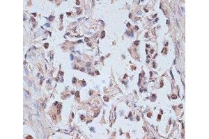 Immunohistochemistry of paraffin-embedded Human lung cancer using TAX1BP1 Polyclonal Antibody at dilution of 1:100 (40x lens). (TAX1BP1 Antikörper)