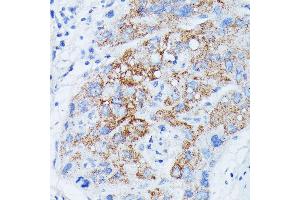 Immunohistochemistry of paraffin-embedded human liver cancer using MANBA antibody (ABIN7268392) at dilution of 1:100 (40x lens). (MANBA Antikörper  (AA 18-300))