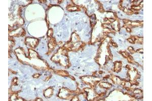 Formalin-fixed, paraffin-embedded human Angiosarcoma stained with CD31 Mouse Monoclonal Antibody (C31. (CD31 Antikörper)