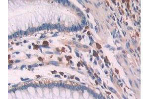 IHC-P analysis of Human Colorectal cancer Tissue, with DAB staining. (OAS1 Antikörper  (AA 74-165))