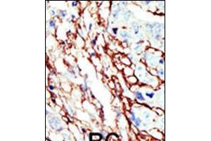 Formalin-fixed and paraffin-embedded human cancer tissue reacted with the primary antibody, which was peroxidase-conjugated to the secondary antibody, followed by AEC staining. (EPH Receptor A7 Antikörper  (C-Term))