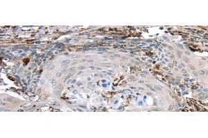 Immunohistochemistry of paraffin-embedded Human cervical cancer using TBXA2R Polyclonal Antibody at dilution of 1/40 (TBXA2R Antikörper)
