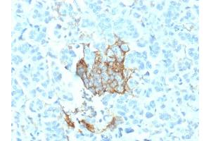 Formalin-fixed, paraffin-embedded human Breast Carcinoma stained with NGFR Mouse Monoclonal Antibody (NGFR/1964).