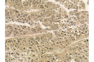 ABIN6265114 and ABIN6276812 at 1/100 staining human hepatocellular carcinoma by IHC-P. (SLC22A5 Antikörper  (C-Term))
