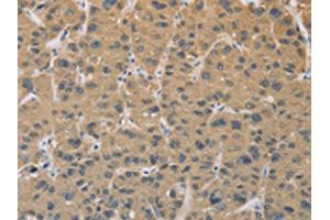 The image on the left is immunohistochemistry of paraffin-embedded Human liver cancer tissue using ABIN7129118(CYFIP2 Antibody) at dilution 1/25, on the right is treated with fusion protein. (CYFIP2 Antikörper)